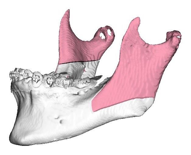 Ostéotomie sagittale planifiée en 3D