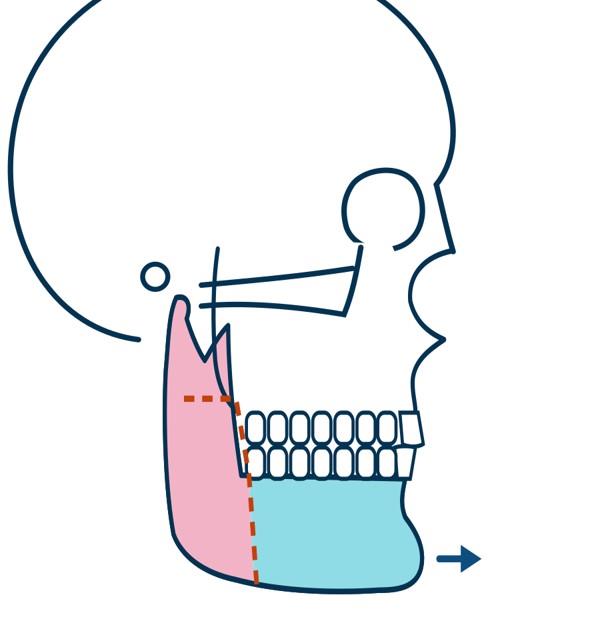 Ostéotomie sagittale de la mandibule