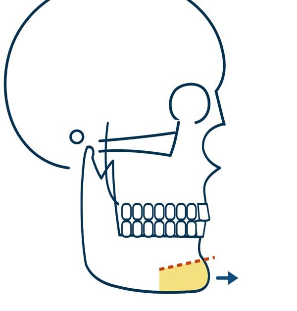 Génioplastie