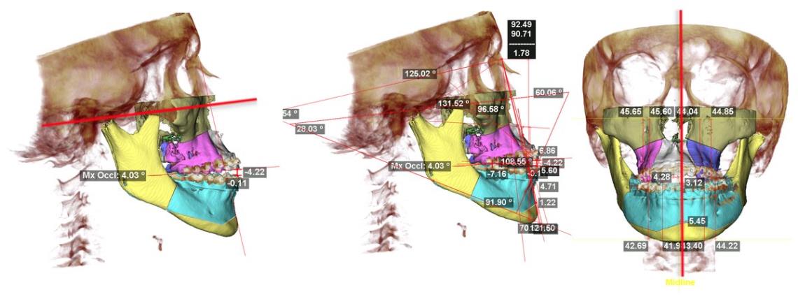 Planification 3D d'une chirurgie orthognathique : mâchoires segmentées en couleur, mesures d'angles et ligne médiane